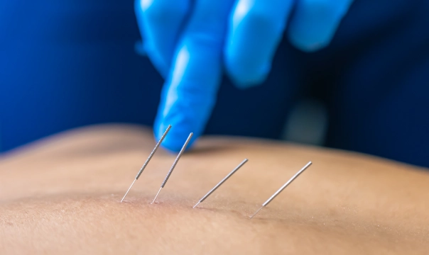 Someone getting Dry Needling